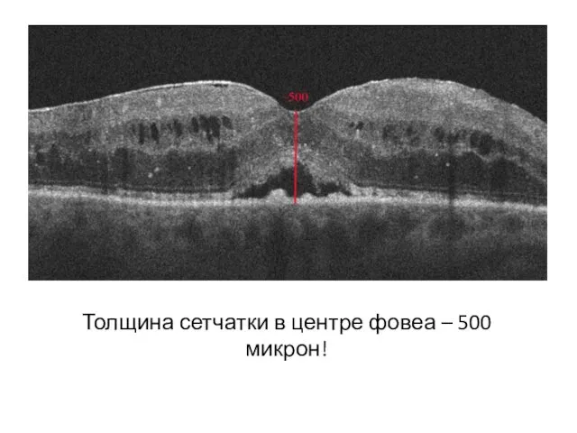 Толщина сетчатки в центре фовеа – 500 микрон!