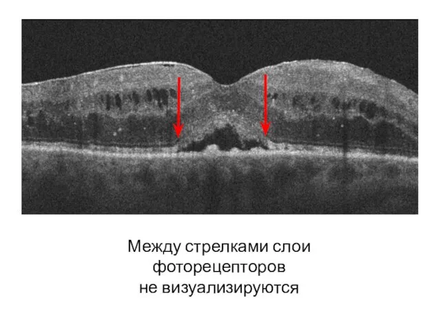 Между стрелками слои фоторецепторов не визуализируются