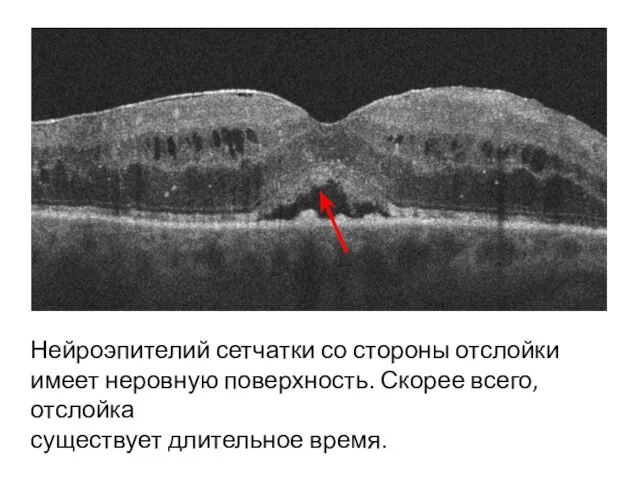 Нейроэпителий сетчатки со стороны отслойки имеет неровную поверхность. Скорее всего, отслойка существует длительное время.