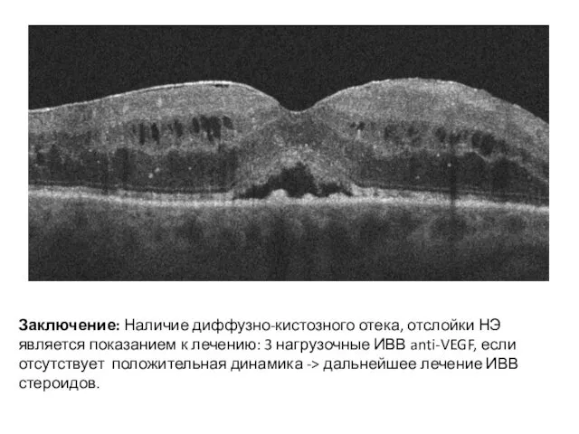 Заключение: Наличие диффузно-кистозного отека, отслойки НЭ является показанием к лечению: 3