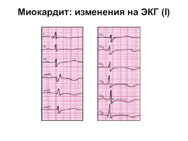 Миокардит: изменения на ЭКГ (I)