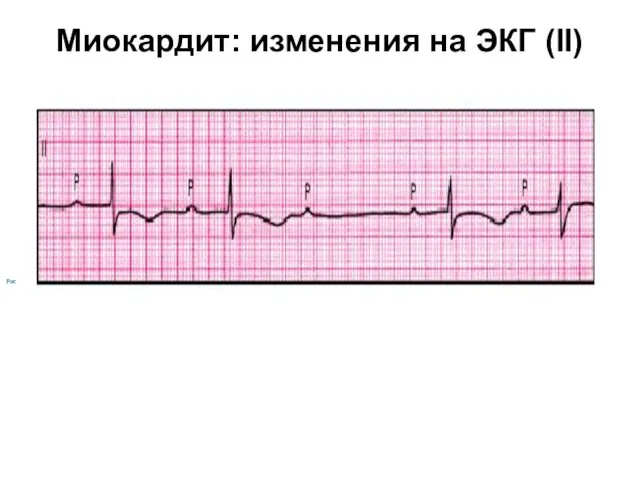 Миокардит: изменения на ЭКГ (II)