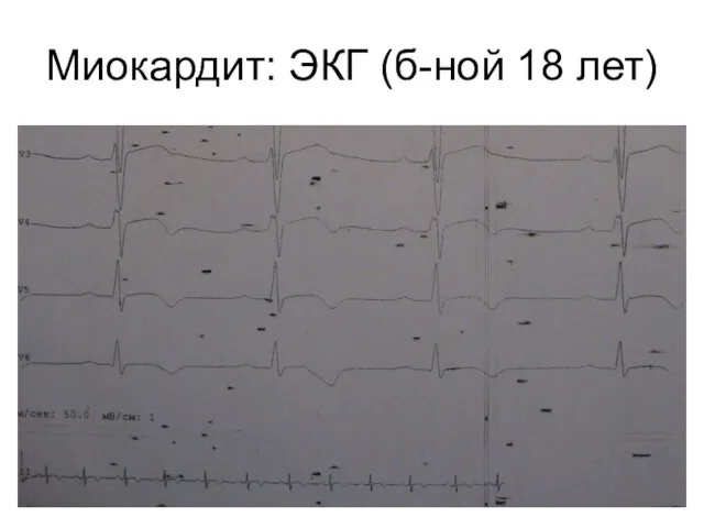 Миокардит: ЭКГ (б-ной 18 лет)