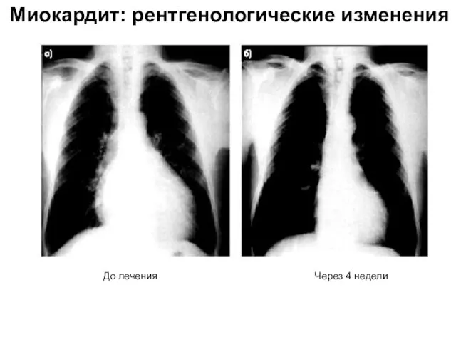 Миокардит: рентгенологические изменения До лечения Через 4 недели