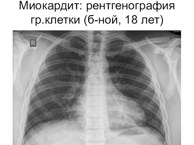 Миокардит: рентгенография гр.клетки (б-ной, 18 лет)