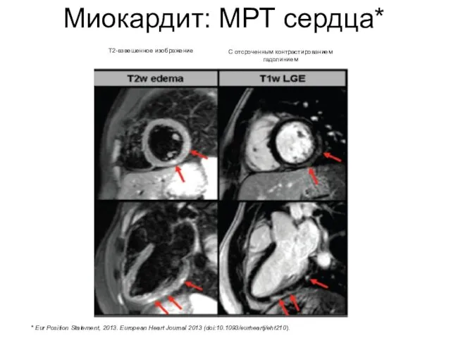 Миокардит: МРТ сердца* * Eur Position Statement, 2013. European Heart Journal