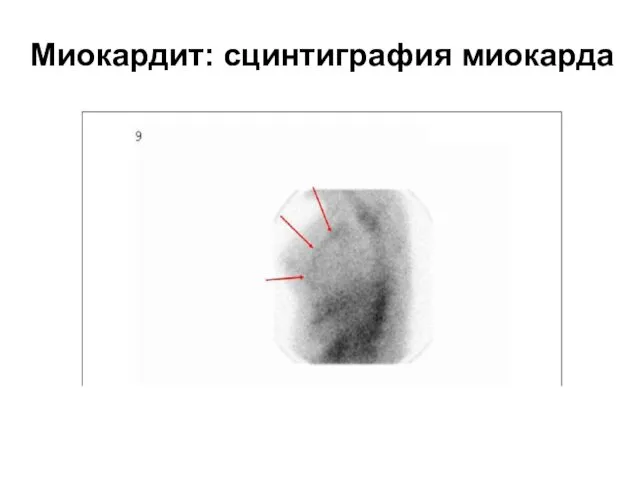 Миокардит: сцинтиграфия миокарда