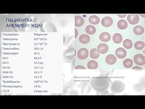 ПАЦИЕНТКА С АНЕМИЕЙ? ЖДА? Заключение: умеренный анизоцитоз, микроциты