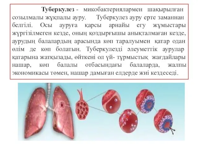 Туберкулез - микобактериялармен шақырылған созылмалы жұқпалы ауру. Туберкулез ауру ерте заманнан