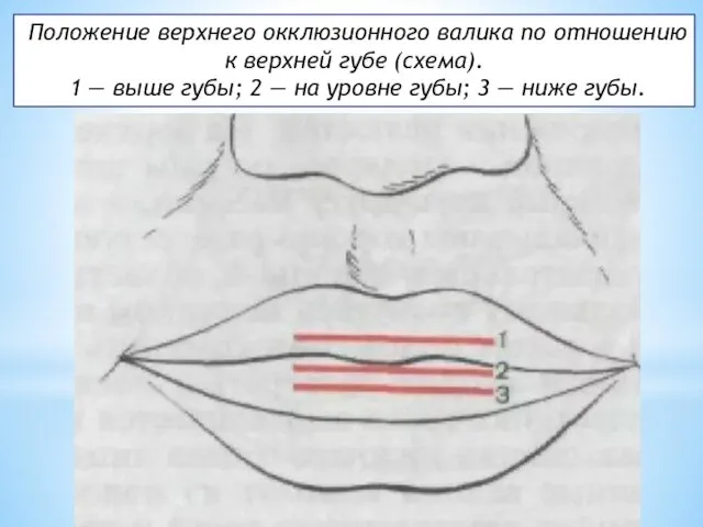 Положение верхнего окклюзионного валика по отношению к верхней губе (схема). 1