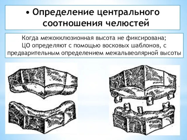 Когда межокклюзионная высота не фиксирована; ЦО определяют с помощью восковых шаблонов,