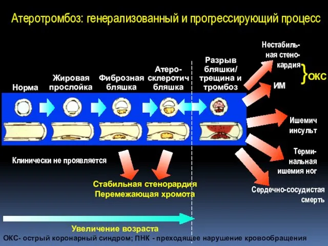 Норма Жировая прослойка Фиброзная бляшка Атеро- склеротич бляшка Разрыв бляшки/ трещина