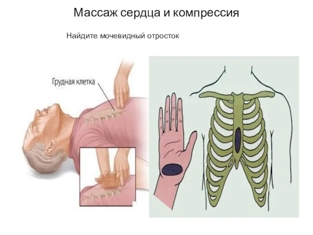 Массаж сердца и компрессия Найдите мочевидный отросток