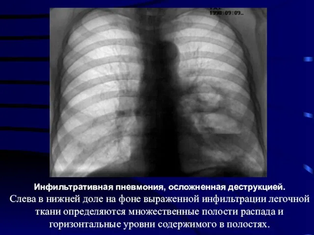 Инфильтративная пневмония, осложненная деструкцией. Слева в нижней доле на фоне выраженной