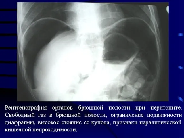 Рентгенография органов брюшной полости при перитоните. Свободный газ в брюшной полости,