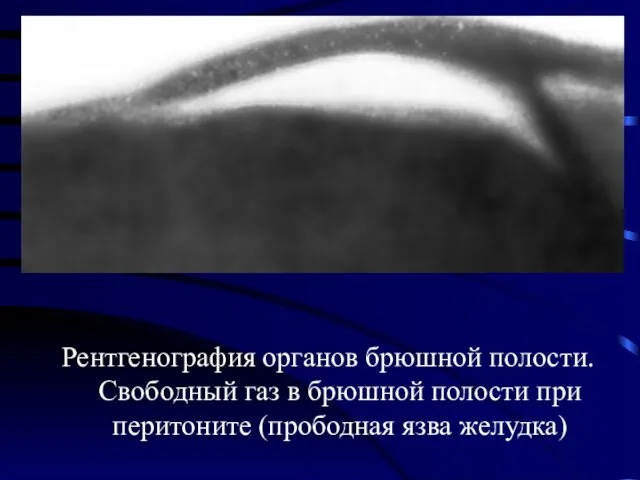 Рентгенография органов брюшной полости. Свободный газ в брюшной полости при перитоните (прободная язва желудка)