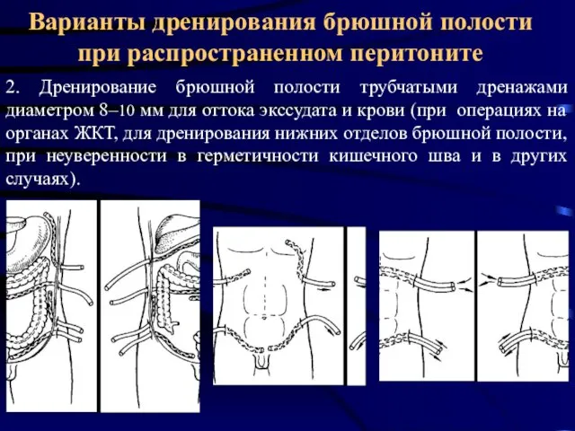 Варианты дренирования брюшной полости при распространенном перитоните 2. Дренирование брюшной полости