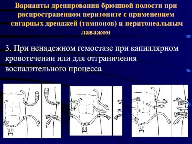 Варианты дренирования брюшной полости при распространенном перитоните с применением сигарных дренажей