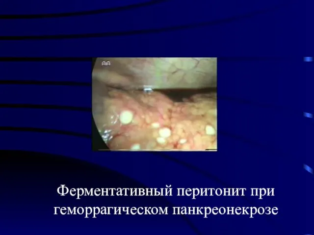 Ферментативный перитонит при геморрагическом панкреонекрозе