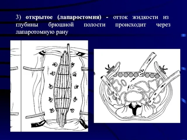 3) открытое (лапаростомия) - отток жидкости из глубины брюшной полости происходит через лапаротомную рану