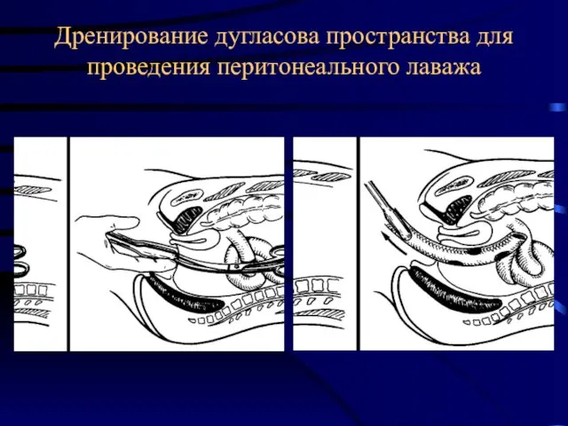 Дренирование дугласова пространства для проведения перитонеального лаважа