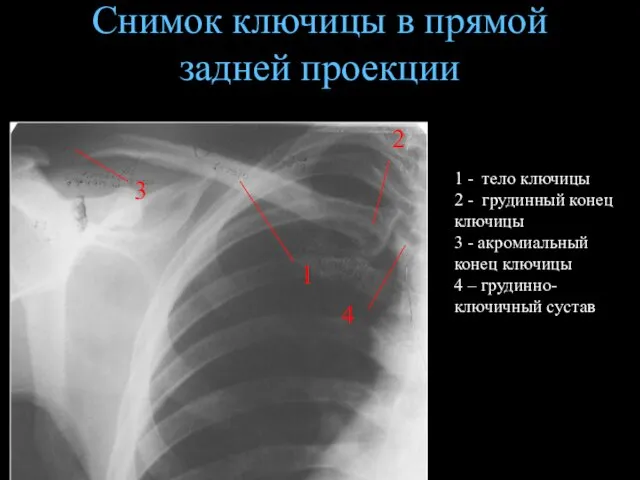 Снимок ключицы в прямой задней проекции 1 - тело ключицы 2