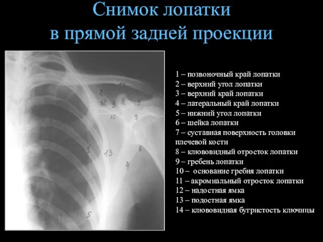 Снимок лопатки в прямой задней проекции 1 – позвоночный край лопатки