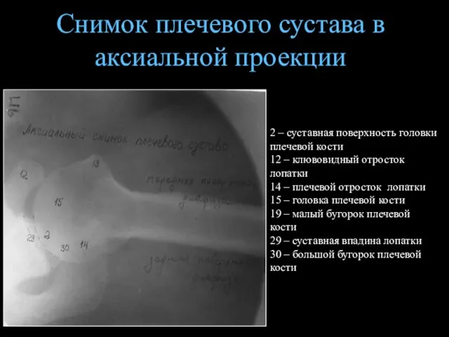 Снимок плечевого сустава в аксиальной проекции 2 – суставная поверхность головки