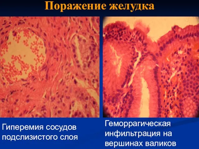 Поражение желудка Гиперемия сосудов подслизистого слоя Геморрагическая инфильтрация на вершинах валиков