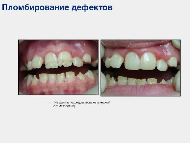 Пломбирование дефектов (Из архива кафедры терапевтической стоматологии)