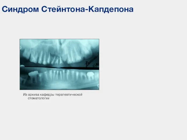 Синдром Стейнтона-Капдепона Из архива кафедры терапевтической стоматологии