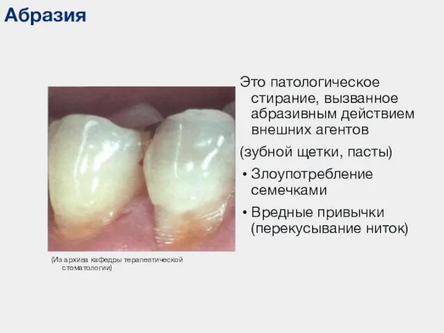 Абразия (Из архива кафедры терапевтической стоматологии) Это патологическое стирание, вызванное абразивным