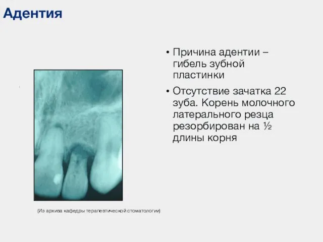 Адентия ( (Из архива кафедры терапевтической стоматологии) Причина адентии – гибель