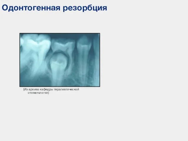 Одонтогенная резорбция (Из архива кафедры терапевтической стоматологии)