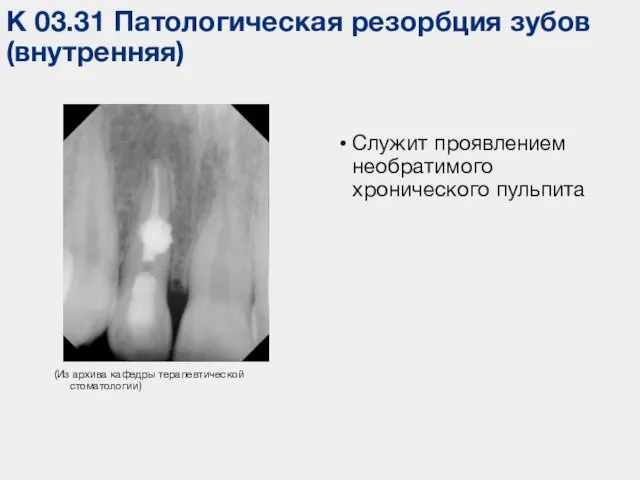 К 03.31 Патологическая резорбция зубов (внутренняя) (Из архива кафедры терапевтической стоматологии) Служит проявлением необратимого хронического пульпита