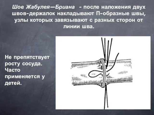 Шов Жабулея—Бриана - после наложения двух швов-держалок накладывают П-образные швы, узлы