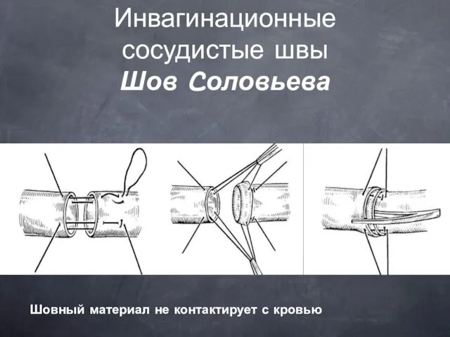 Инвагинационные сосудистые швы Шов Cоловьева Шовный материал не контактирует с кровью