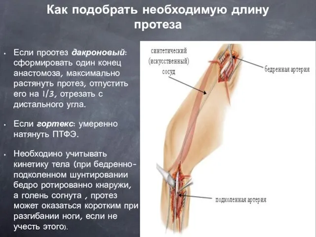 Как подобрать необходимую длину протеза Если проотез дакроновый: сформировать один конец