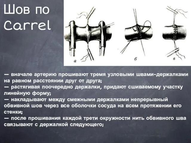 Шов по Carrel — вначале артерию прошивают тремя узловыми швами-держалками на