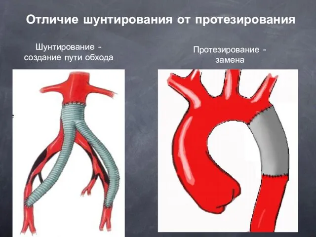 Отличие шунтирования от протезирования Шунтирование - создание пути обхода Протезирование - замена