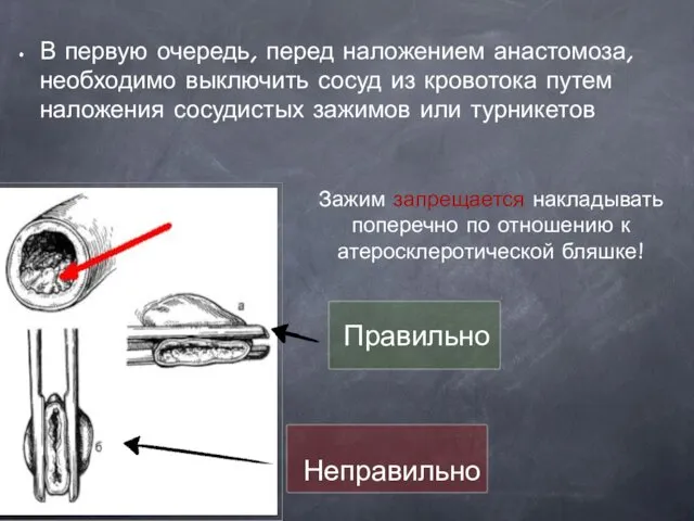 В первую очередь, перед наложением анастомоза, необходимо выключить сосуд из кровотока