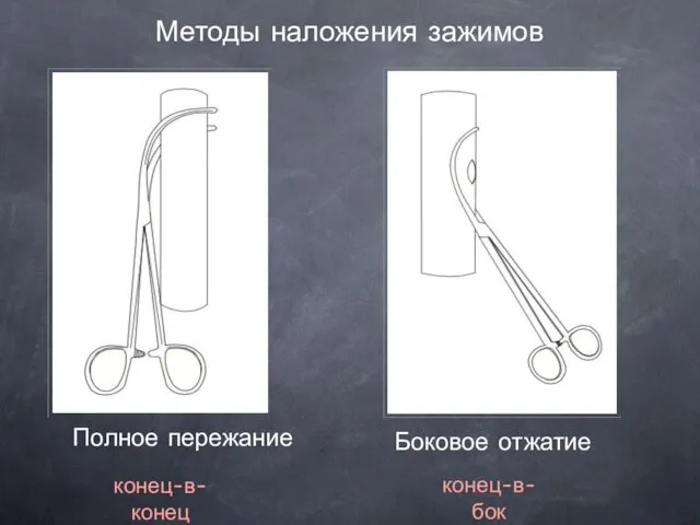 Методы наложения зажимов Полное пережание Боковое отжатие конец-в-конец конец-в-бок