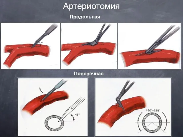 Артериотомия Продольная Поперечная