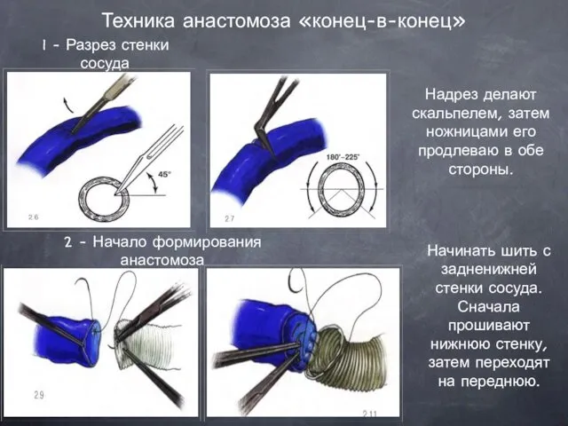 Техника анастомоза «конец-в-конец» 1 - Разрез стенки сосуда 2 - Начало