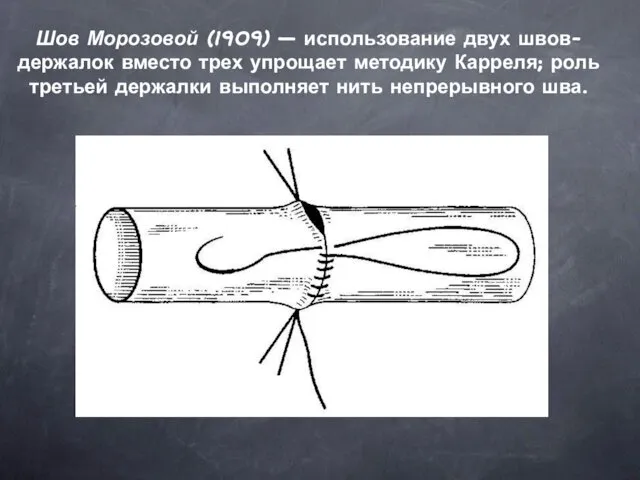 Шов Морозовой (1909) — использование двух швов-держалок вместо трех упрощает методику