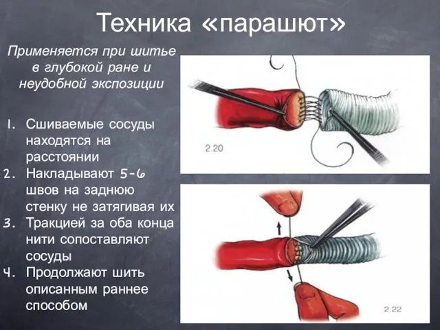 Техника «парашют» Применяется при шитье в глубокой ране и неудобной экспозиции