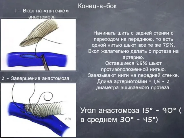 Конец-в-бок 1 - Вкол на «пяточке» анастомоза Начинать шить с задней