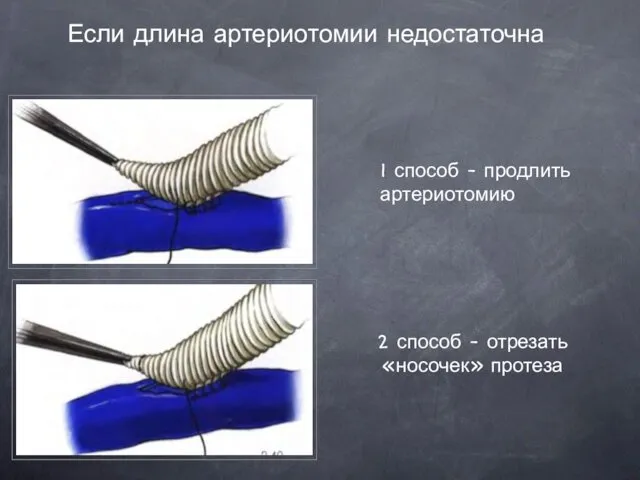 Если длина артериотомии недостаточна 1 способ - продлить артериотомию 2 способ - отрезать «носочек» протеза