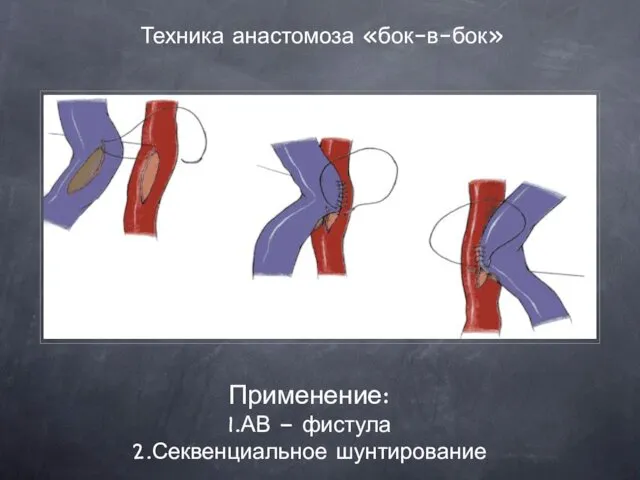 Техника анастомоза «бок-в-бок» Применение: 1.АВ – фистула 2.Секвенциальное шунтирование