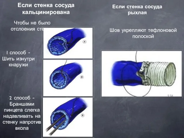 Если стенка сосуда кальцинирована Если стенка сосуда рыхлая Чтобы не было